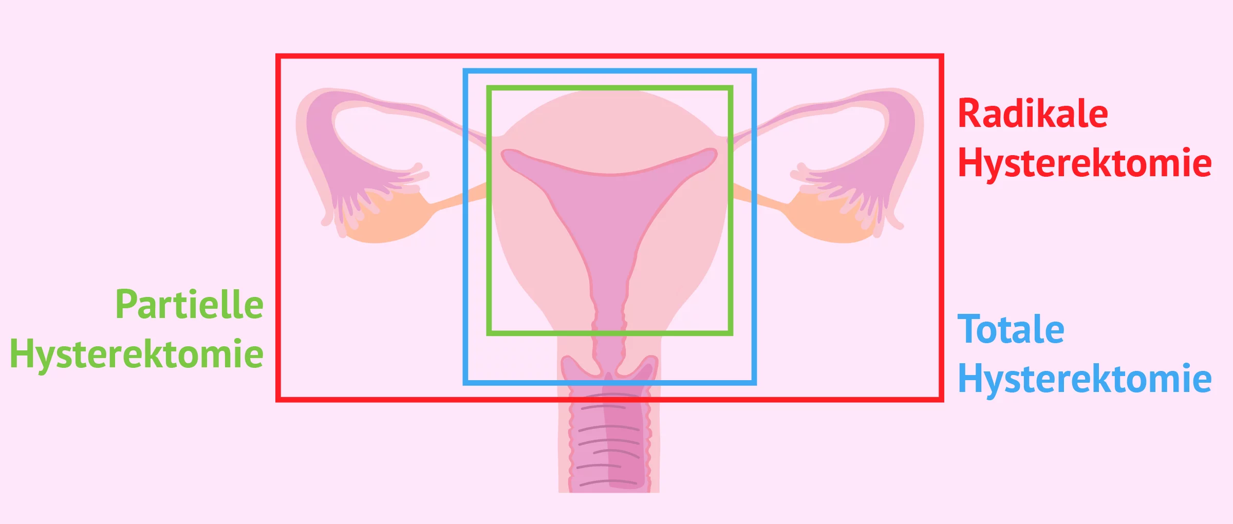 Arten von Hysterektomie