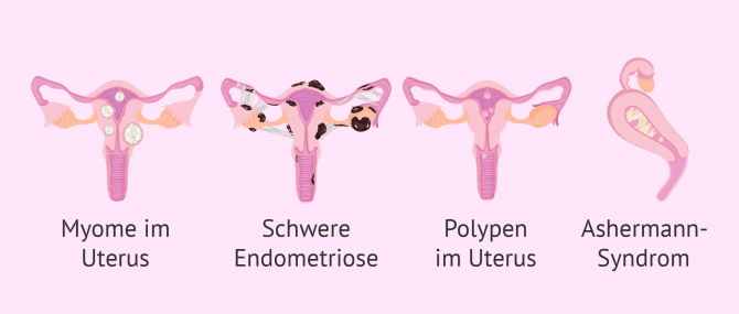 Imagen: Fehlbildungen im Uterus und Leihmutterschaft