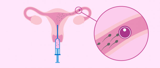 Imagen: Intrauterine Insemination in der Leihmutterschaft