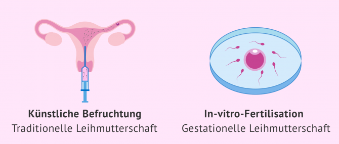 Imagen: künstliche Befruchtung und IVF bei der Leihmutterschaft