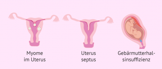Imagen: Fehlbildungen im Uterus die zu Fehlgeburten führen