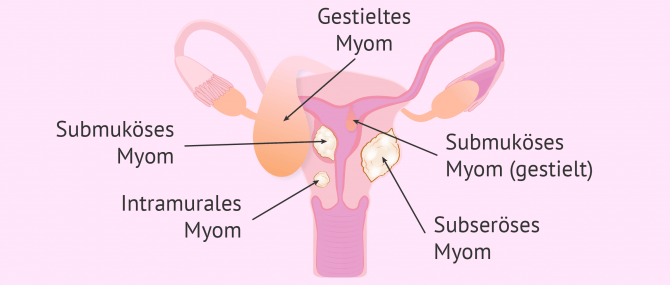 Imagen: Arten von Myome in der Gebärmutter