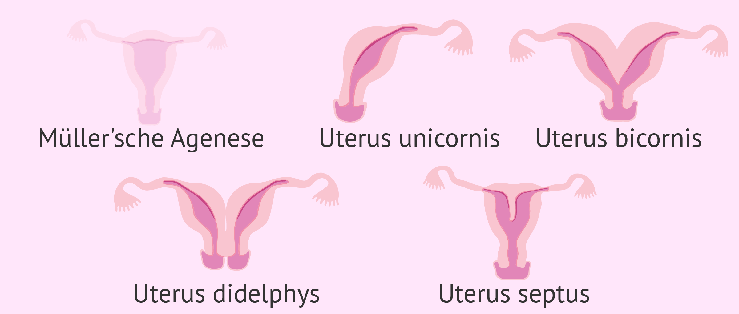 Fehlbildungen im Uterus