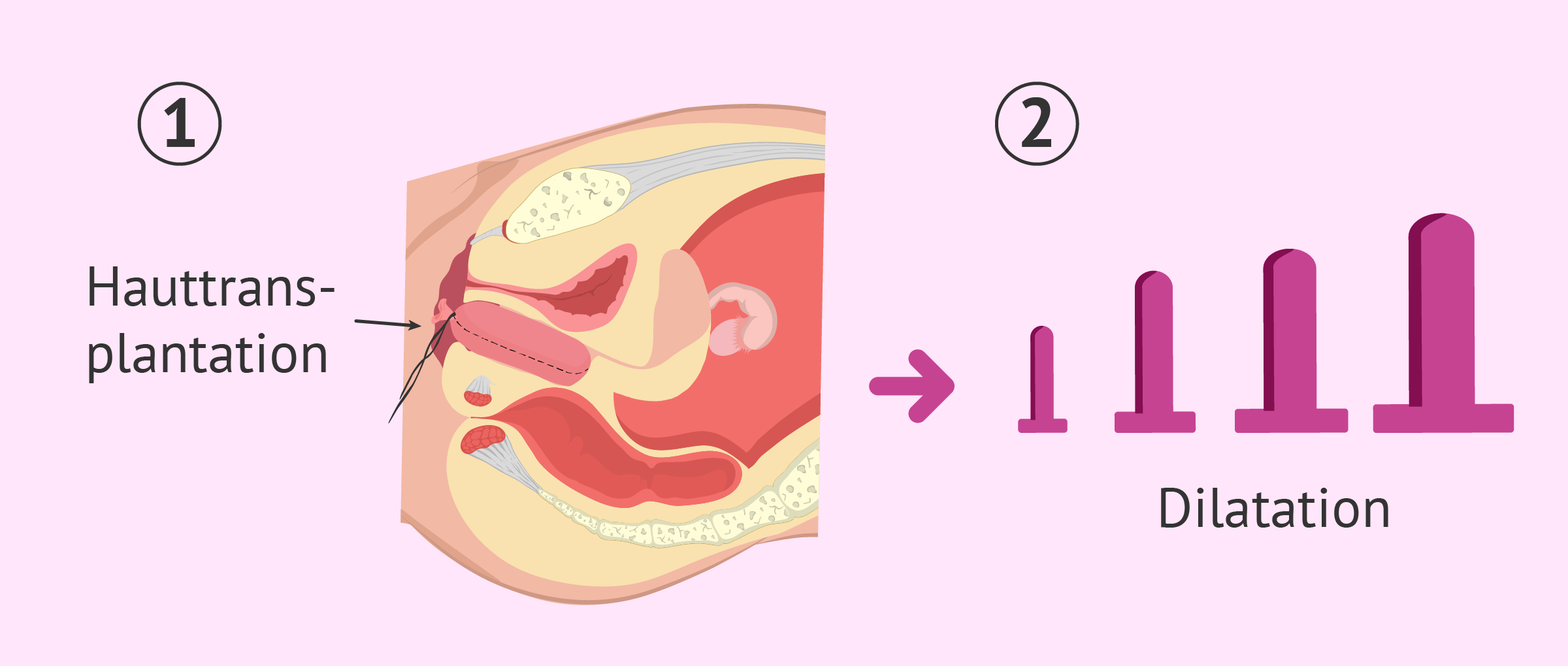 Operativer Eingriff um eine Vagina nachzubilden