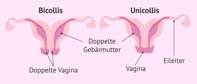 Imagen: Uterus didelphys