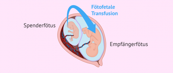 Imagen: Fötofetales Transfusionssyndrom (FFTS)