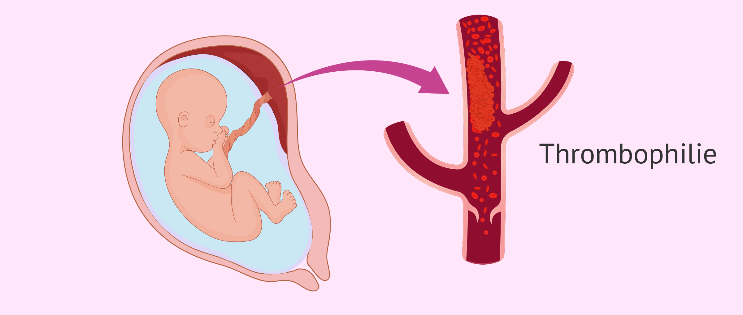 Thrombophilie und Schwangerschaft: Ursache und Behandlung