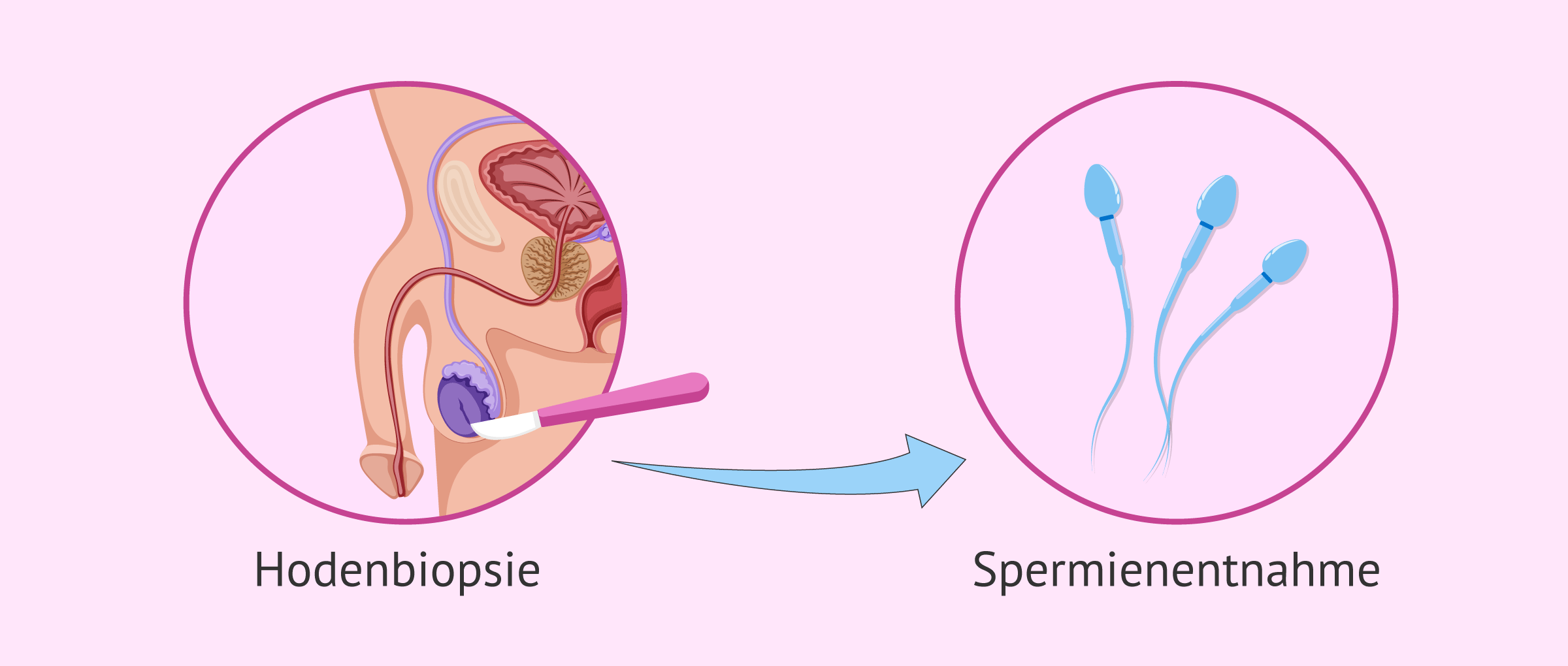 Hodenbiopsie zur Überprüfung der Spermienproduktion