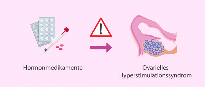 Imagen: Ovarielles Hyperstimulationssyndrom OHSS