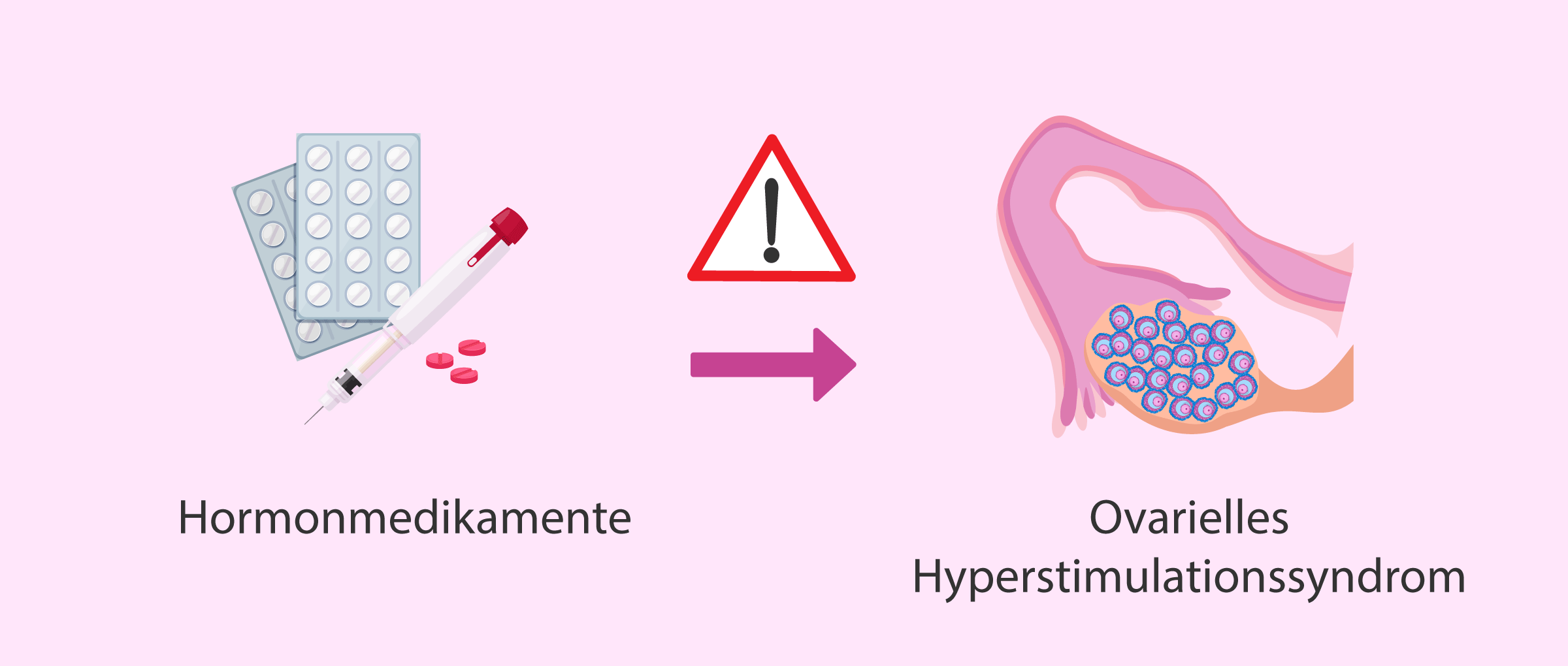 Ovarielles Hyperstimulationssyndrom OHSS