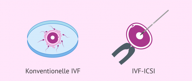 Imagen: Klassische IVF vs. IVF-ICSI