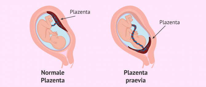 Imagen: Plazenta praevia in der Zwillingsschwangerschaft