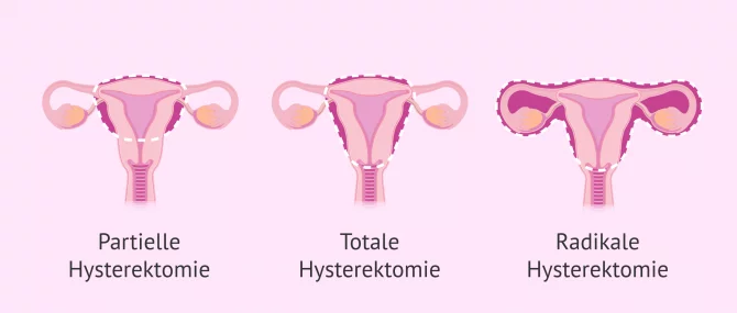 Hysterektomie nach litdecomno: schmerzen Gebärmutterentfernung