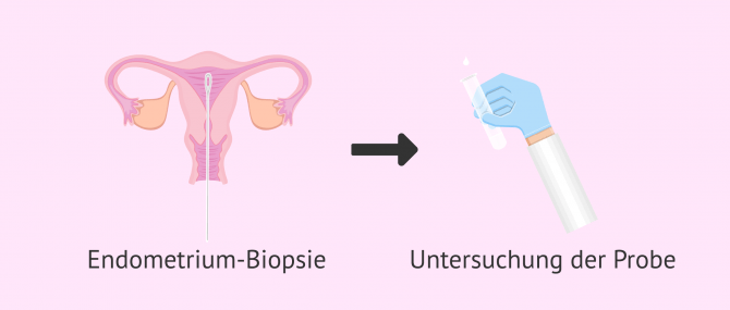 Imagen: Biopsie der Gebärmutterschleimhaut