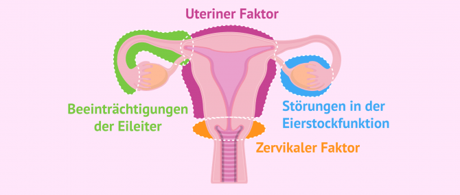 Imagen: Ursachen weiblicher Sterilität