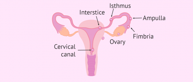 Imagen: ectopic pregnancy