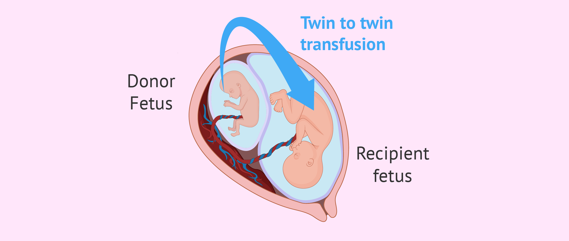 Twin to twin transfusion syndrome (TTFS)