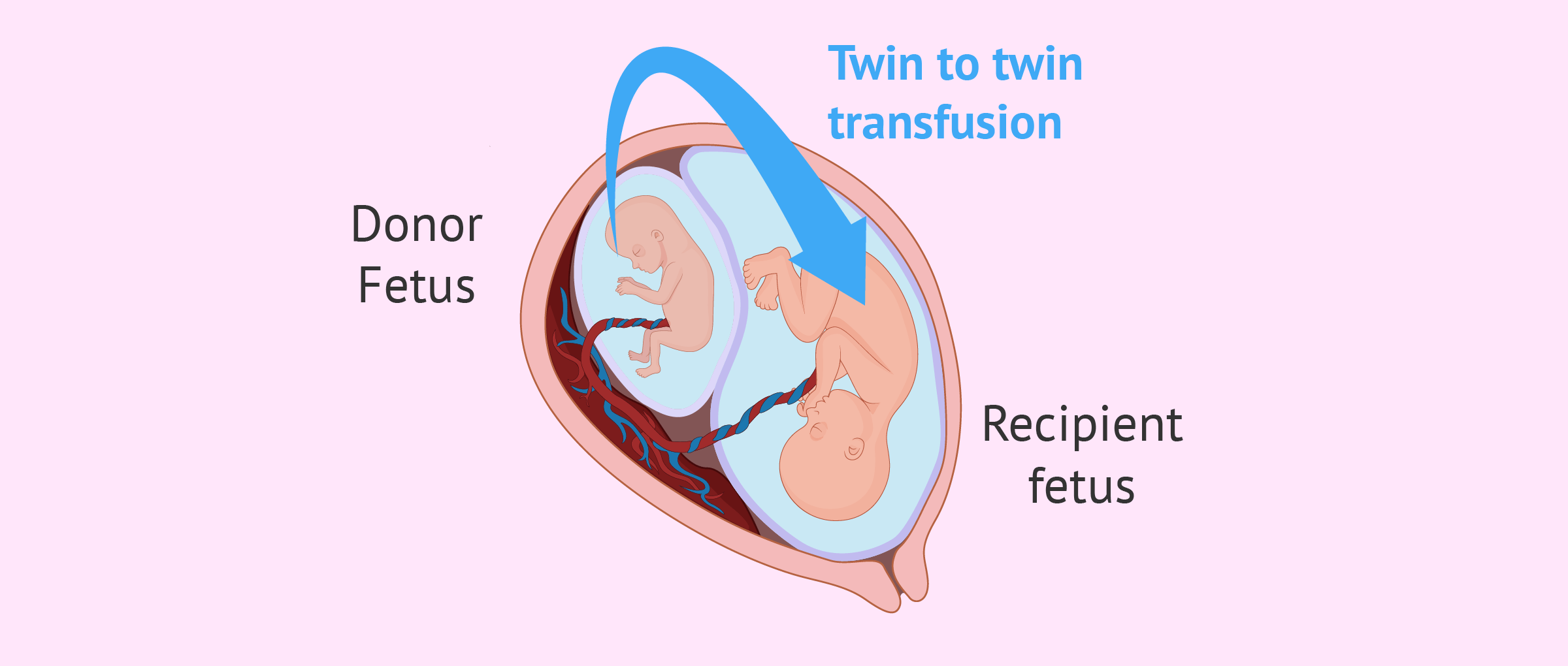 twin-to-twin-transfusion-syndrome-ttfs