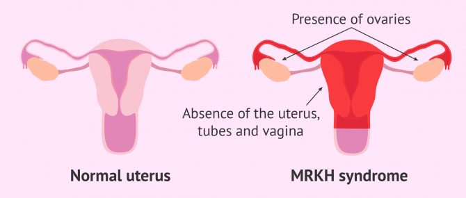 Comparison between normal uterus and MRKH syndrome