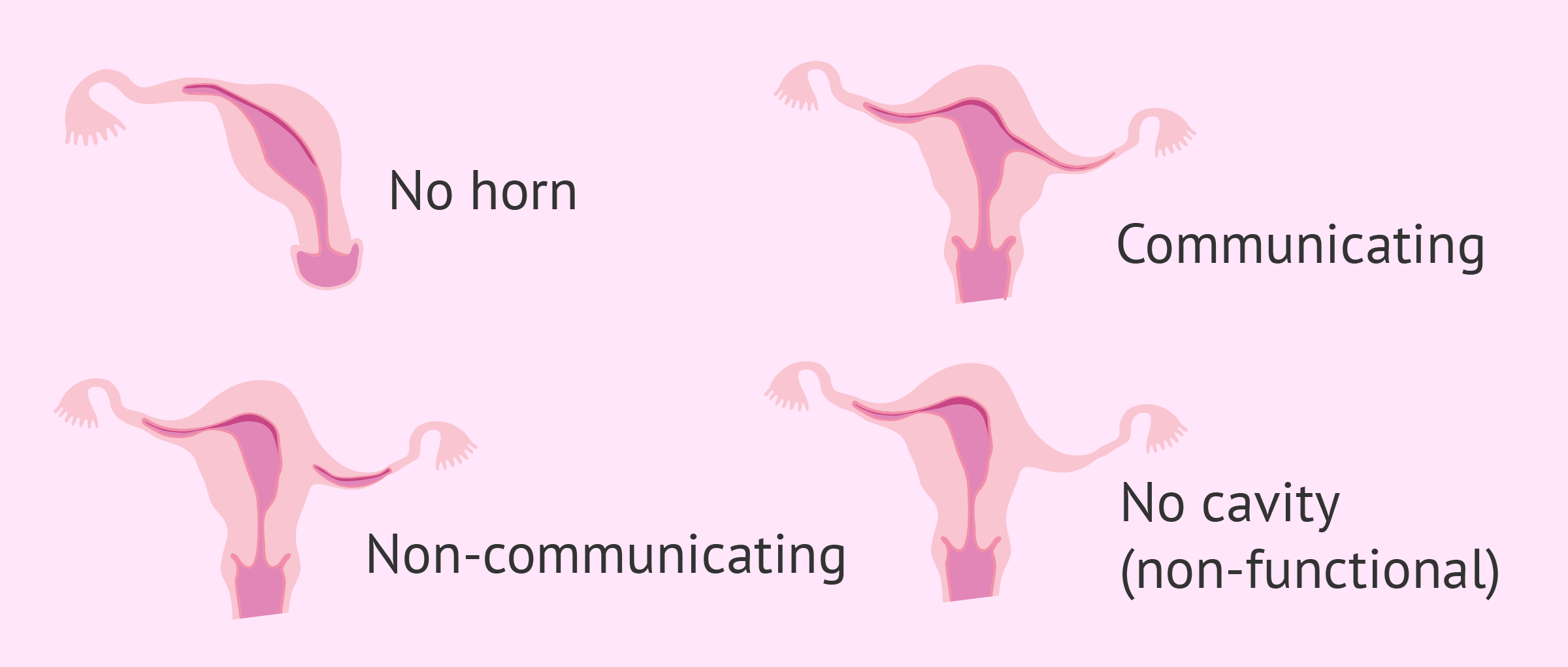 Types Of Unicornuate Uterus