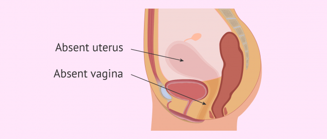 Diagram showing reproductive system in Müllerian agenesis