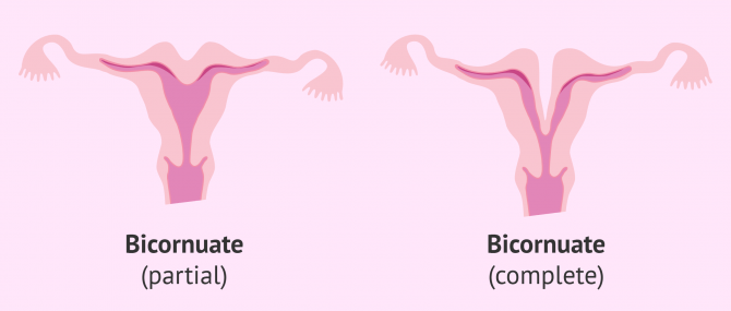 Partial vs. complete bicornuate uterus