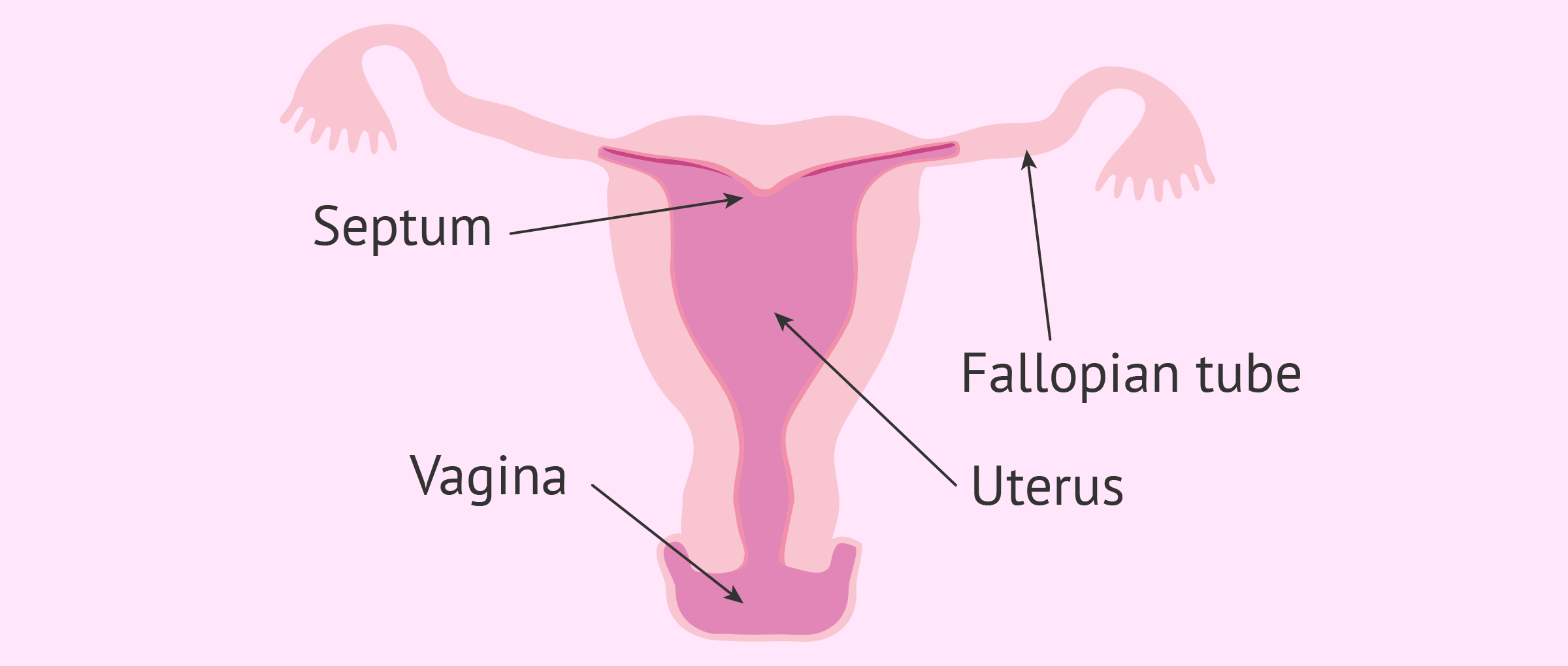 What is an arcuate uterus?