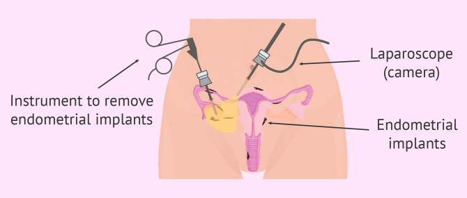Treating endometriosis with surgery
