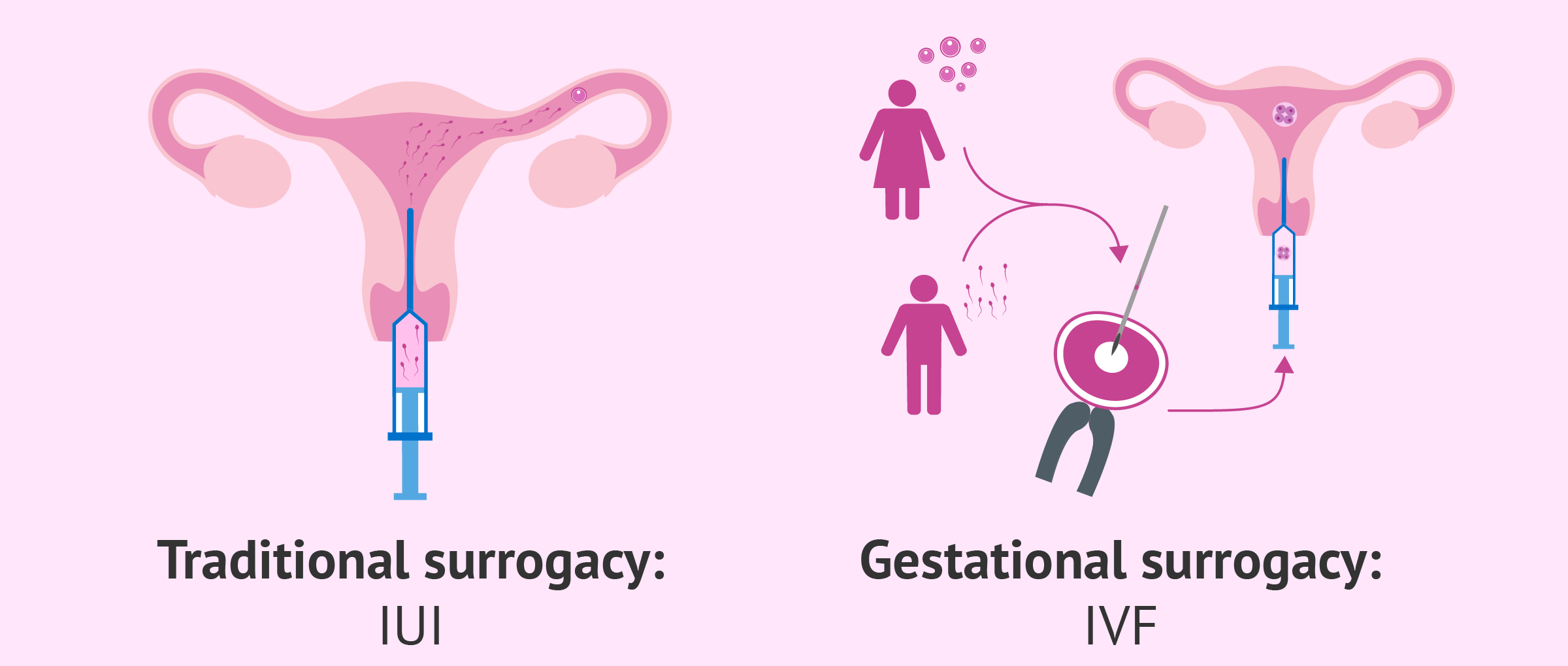Traditional surrogate vs. gestational surrogate