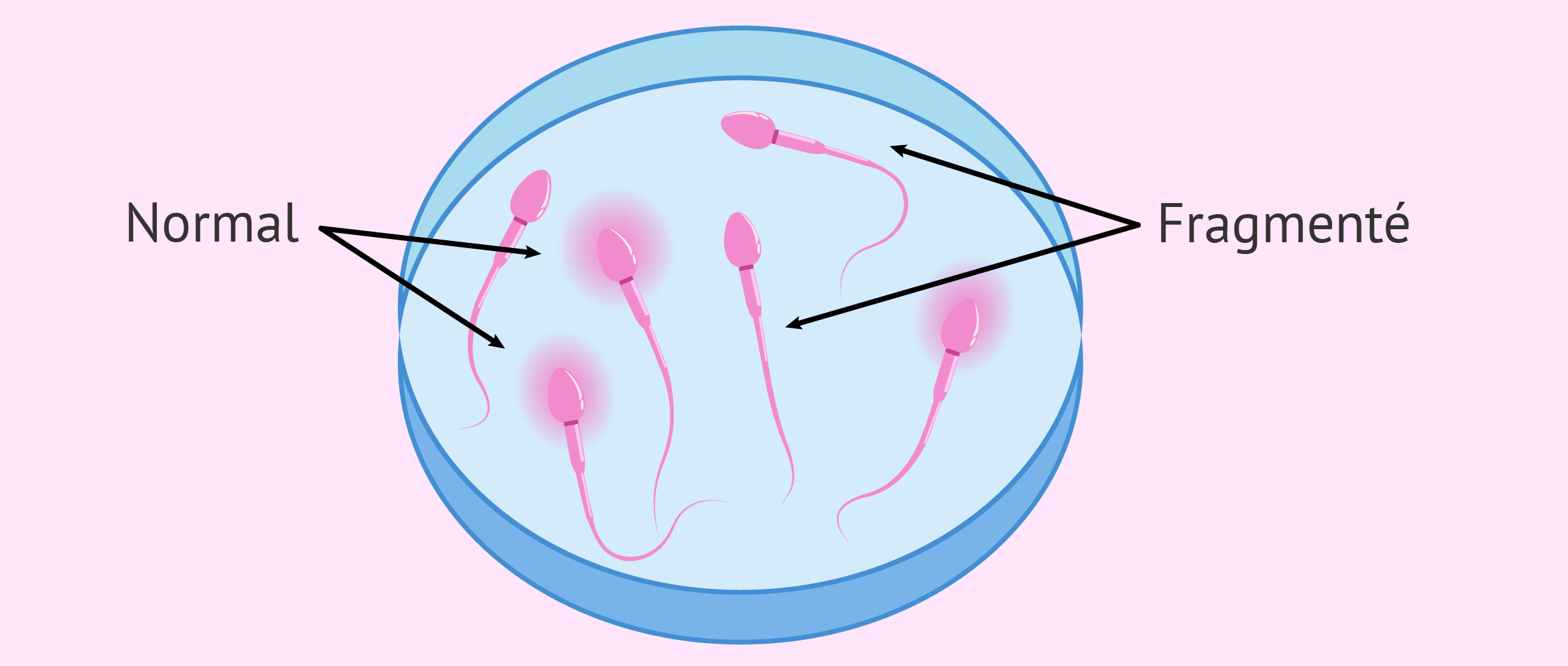 Spermotozoa DNA Fragmentation