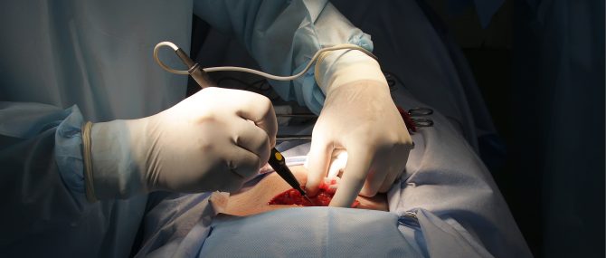 Imagen: Hysterectomy to treat uterine cancer
