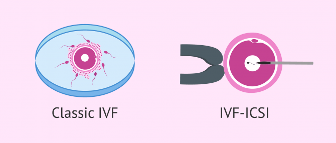 Imagen: Classic IVF vs. IVF-ICSI