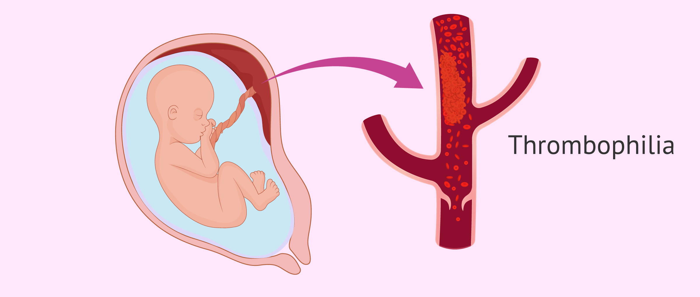 Thrombophilia during pregnancy