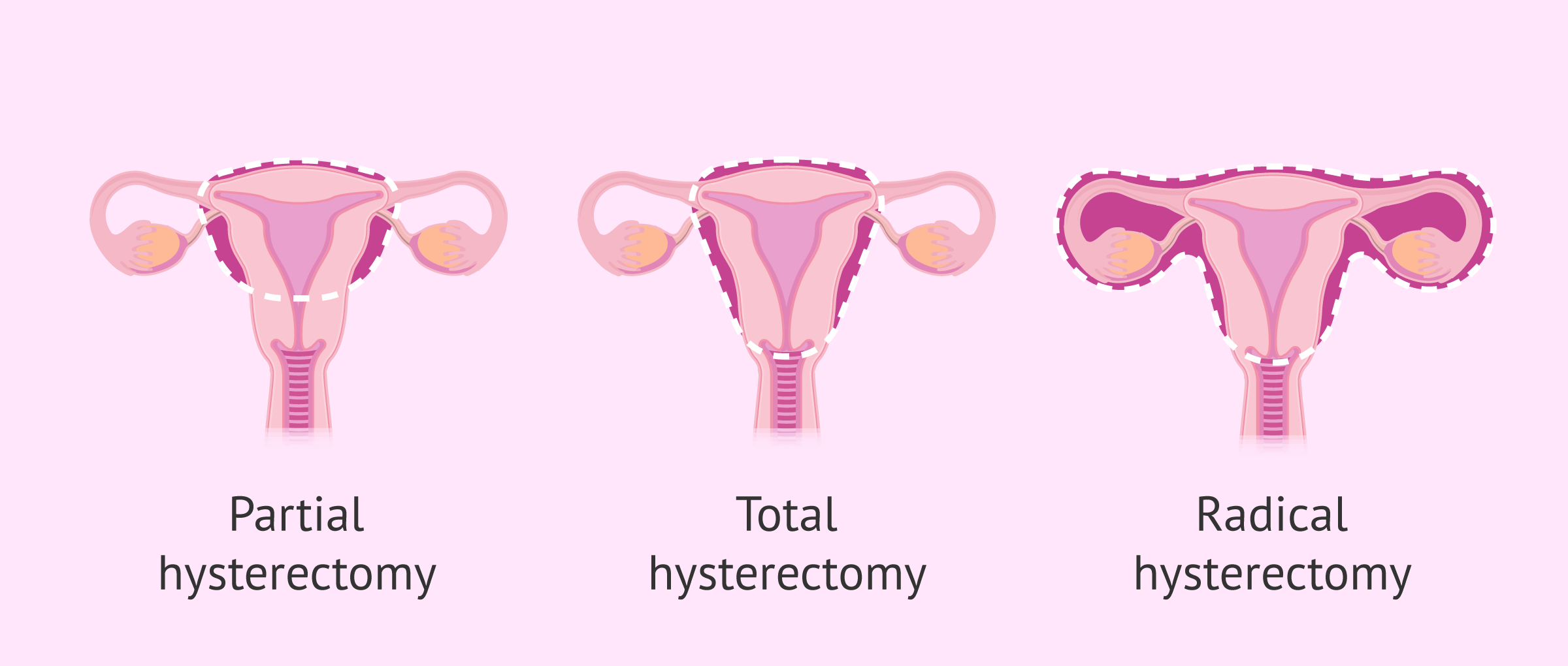 how long does a radical hysterectomy take