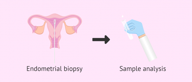 Imagen: Endometrial biopsy technique