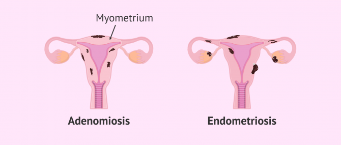 Imagen: Uterus with adenomyosis and uterus with endometriosis