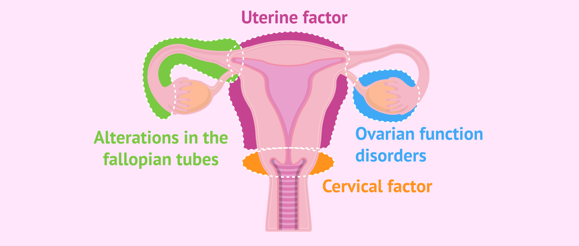 Main causes of female sterility