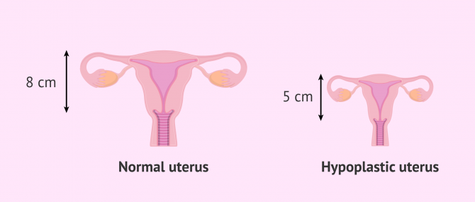 Imagen: What is a hypoplastic uterus?