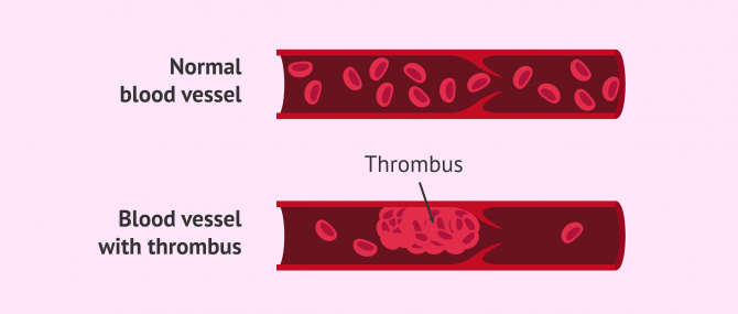 Imagen: Thrombophilia in pregnancy