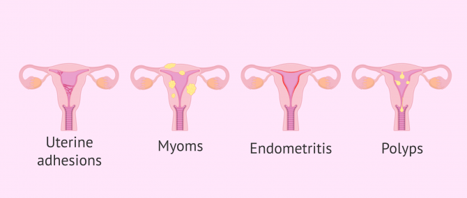 Imagen: uterine adhesions and polyps