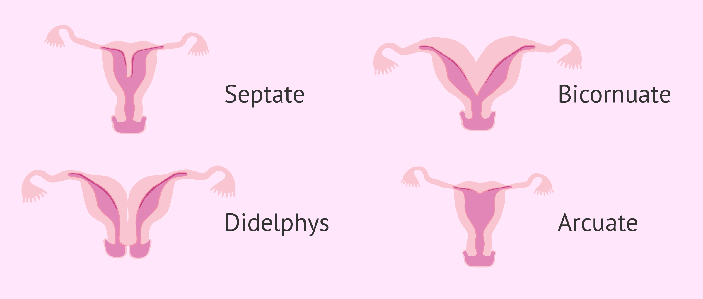 Common uterine malformations