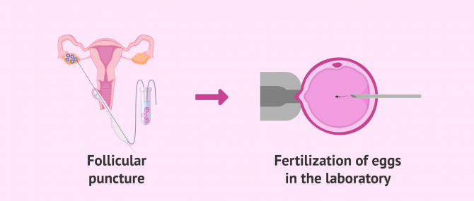 Imagen: Follicular punction and fertilization