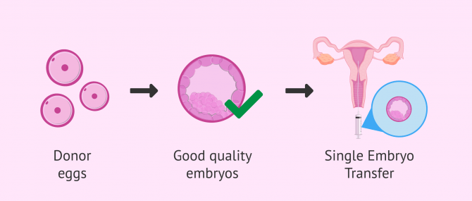 Imagen: Single embryo transfer for the gestational carrier