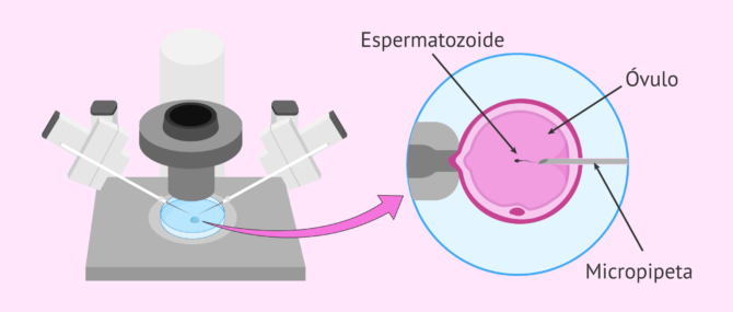 Microinyección del espermatozoide en el óvulo