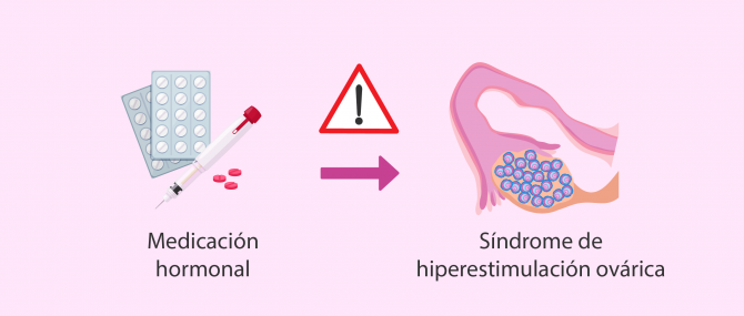 Imagen: Síndrome de hiperestimulación ovárica (SHO)