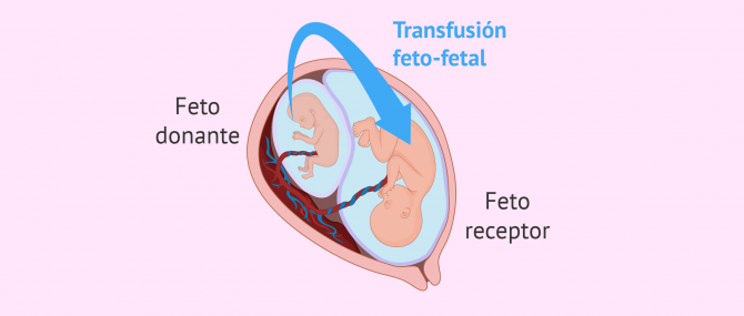 Imagen: Síndrome de transfusión feto-fetal (STFF)