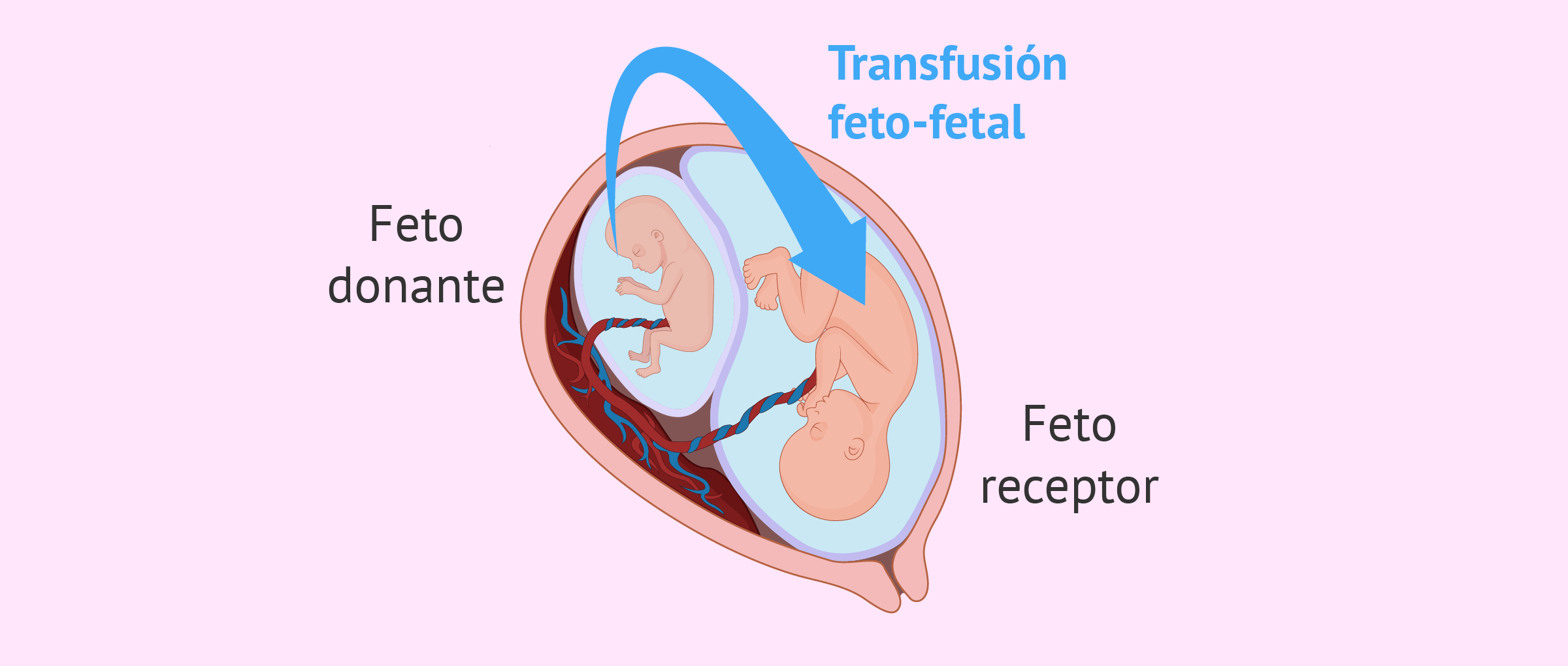 Síndrome de transfusión feto-fetal (STFF)