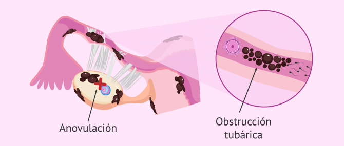 Dificultad implantatoria