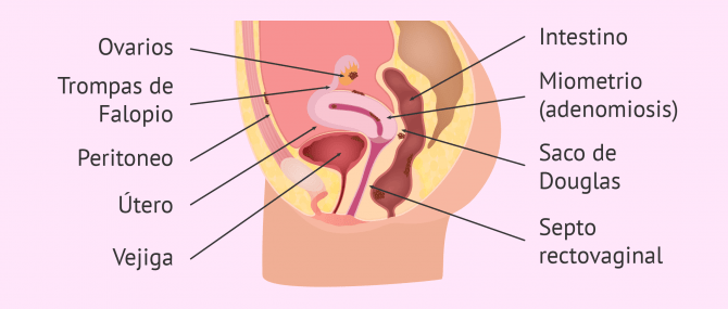 Localización de la endometriosis