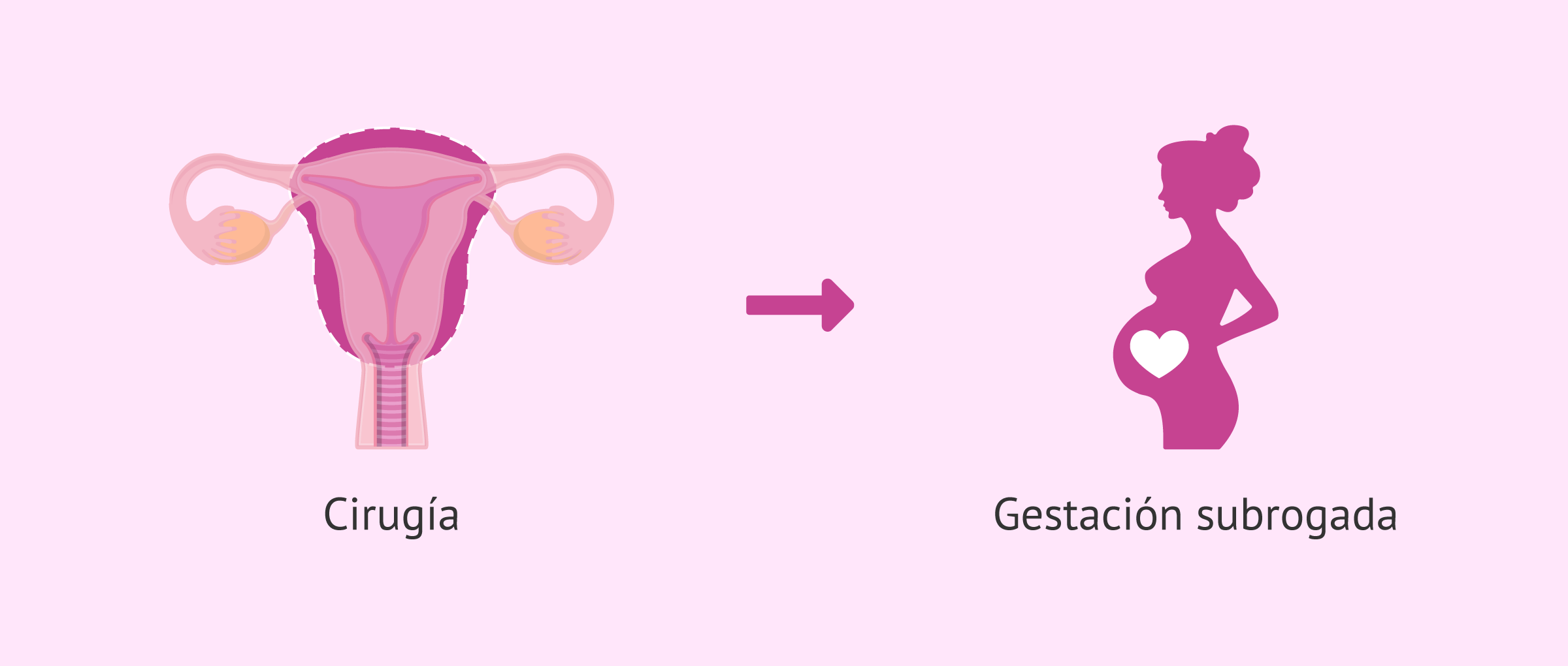 Embarazo tras el tratamiento del cáncer de útero